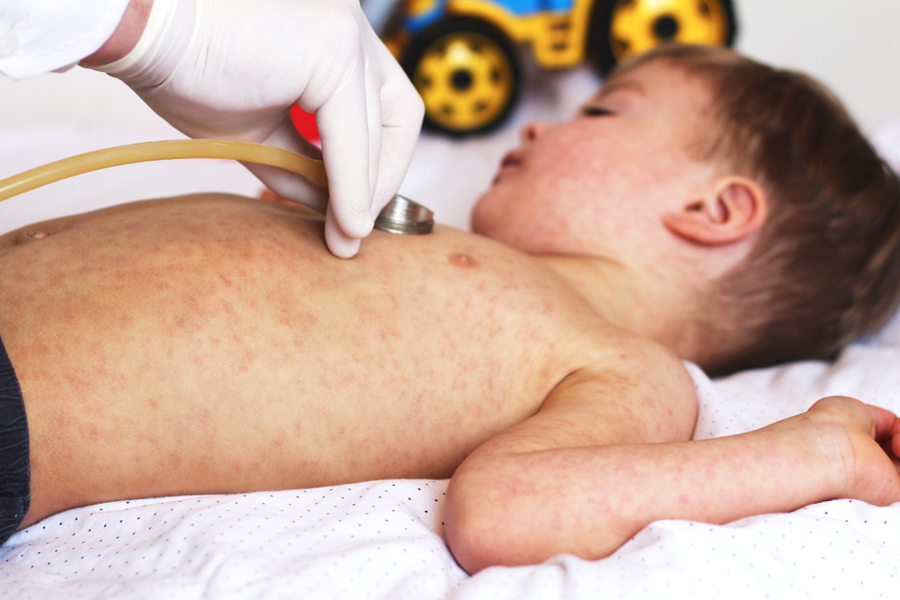Síndrome Inflamatória Multissistêmica Pediátrica