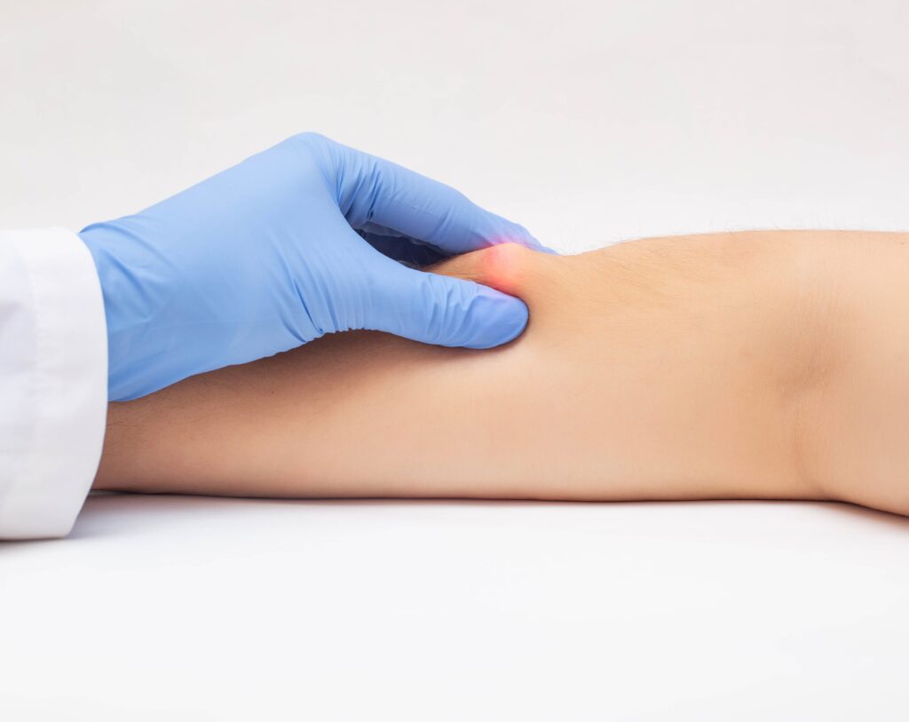 lipoma